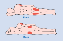 Figure J: Image of Common injection sites for Glucagon: upper arms, thighs, or buttocks